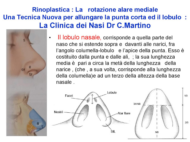86-bis-rinoplastica-una-tecnica-nuova-pe-allungare-il-naso-corto-la-rotazione-alare-mediale-page-002