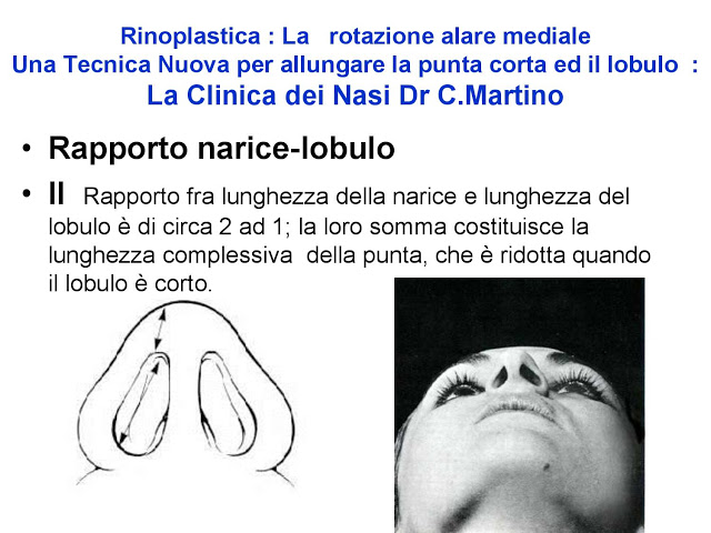 86-bis-rinoplastica-una-tecnica-nuova-pe-allungare-il-naso-corto-la-rotazione-alare-mediale-page-003