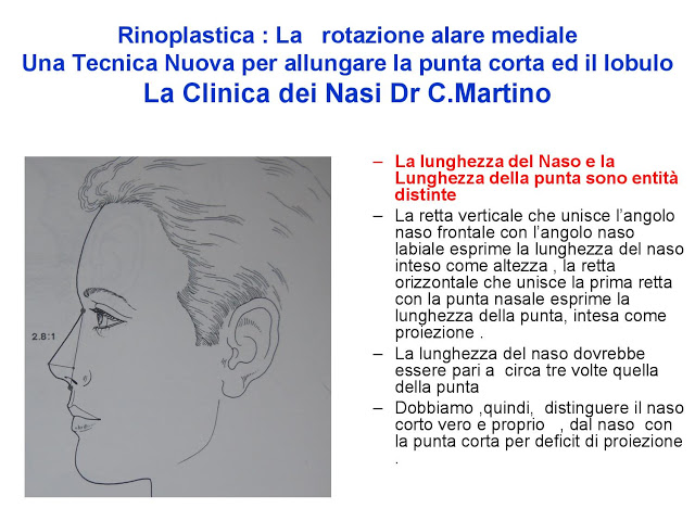 86-bis-rinoplastica-una-tecnica-nuova-pe-allungare-il-naso-corto-la-rotazione-alare-mediale-page-006