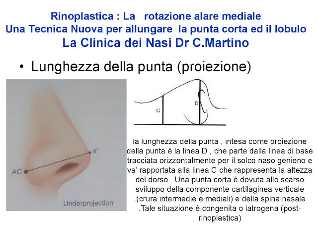 86-bis-rinoplastica-una-tecnica-nuova-pe-allungare-il-naso-corto-la-rotazione-alare-mediale-page-008