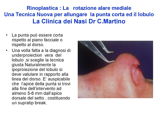 86-bis-rinoplastica-una-tecnica-nuova-pe-allungare-il-naso-corto-la-rotazione-alare-mediale-page-009