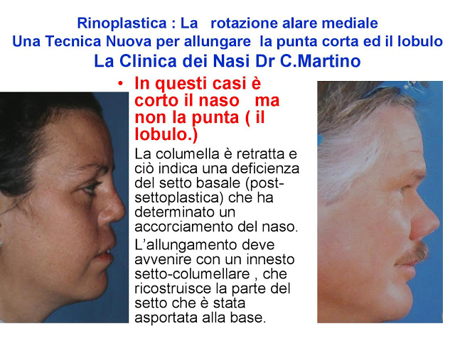 86-bis-rinoplastica-una-tecnica-nuova-pe-allungare-il-naso-corto-la-rotazione-alare-mediale-page-011