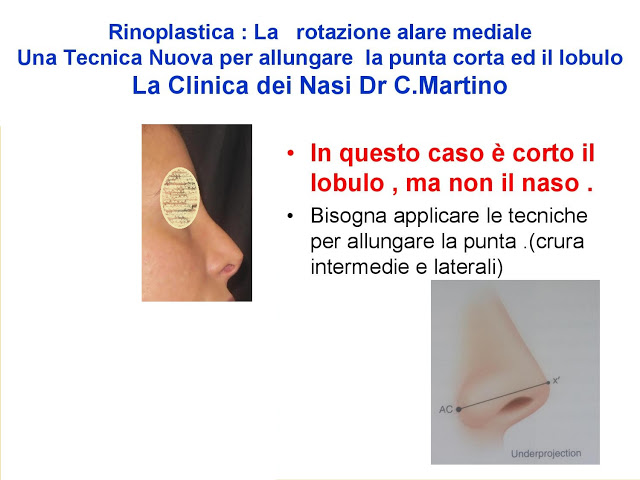 86-bis-rinoplastica-una-tecnica-nuova-pe-allungare-il-naso-corto-la-rotazione-alare-mediale-page-014