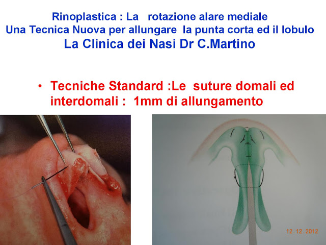 86-bis-rinoplastica-una-tecnica-nuova-pe-allungare-il-naso-corto-la-rotazione-alare-mediale-page-017