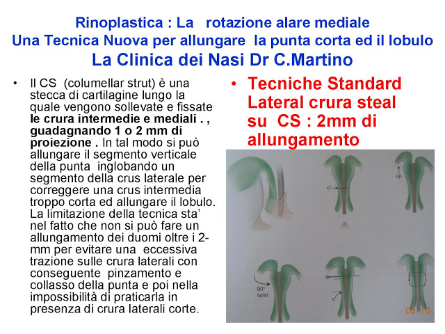 86-bis-rinoplastica-una-tecnica-nuova-pe-allungare-il-naso-corto-la-rotazione-alare-mediale-page-018