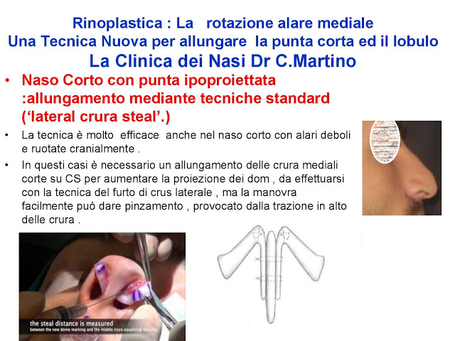 86-bis-rinoplastica-una-tecnica-nuova-pe-allungare-il-naso-corto-la-rotazione-alare-mediale-page-019
