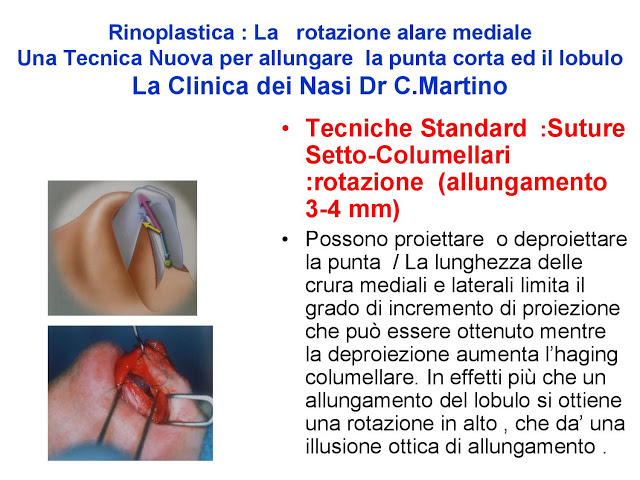 86-bis-rinoplastica-una-tecnica-nuova-pe-allungare-il-naso-corto-la-rotazione-alare-mediale-page-022