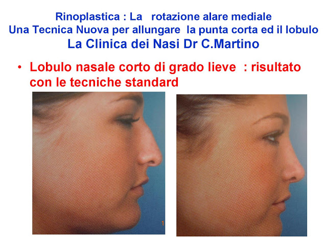 86-bis-rinoplastica-una-tecnica-nuova-pe-allungare-il-naso-corto-la-rotazione-alare-mediale-page-023