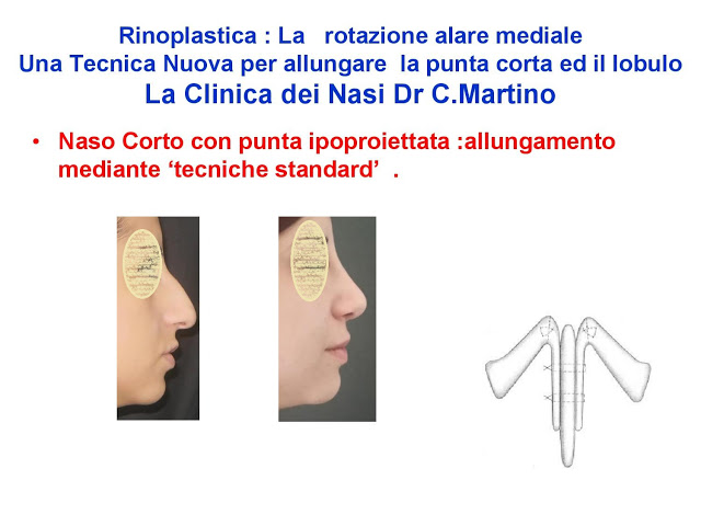 86-bis-rinoplastica-una-tecnica-nuova-pe-allungare-il-naso-corto-la-rotazione-alare-mediale-page-025