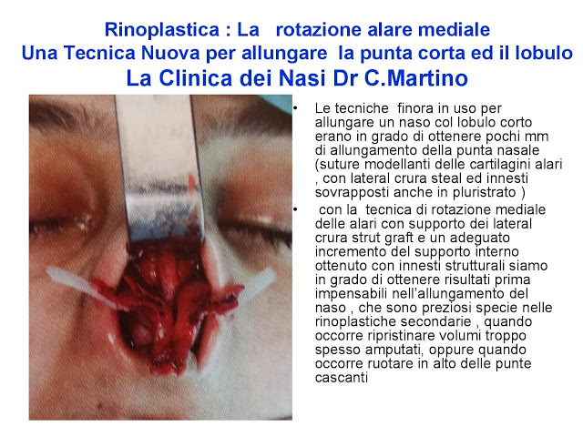 86-bis-rinoplastica-una-tecnica-nuova-pe-allungare-il-naso-corto-la-rotazione-alare-mediale-page-027