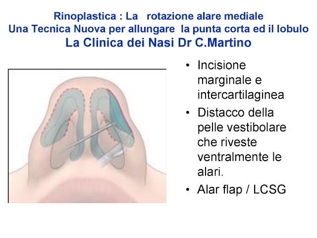 86-bis-rinoplastica-una-tecnica-nuova-pe-allungare-il-naso-corto-la-rotazione-alare-mediale-page-028
