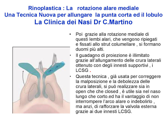 86-bis-rinoplastica-una-tecnica-nuova-pe-allungare-il-naso-corto-la-rotazione-alare-mediale-page-030