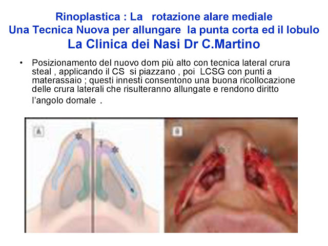 86 bis  Rinoplastica   Una tecnica nuova pe allungare  il naso corto   (la rotazione alare mediale)  -page-032