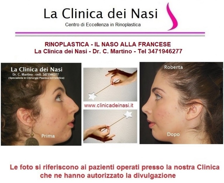 RINOPLASTICA: IL NASO ALLA FRANCESE – Dott. Carmine Martino – Napoli